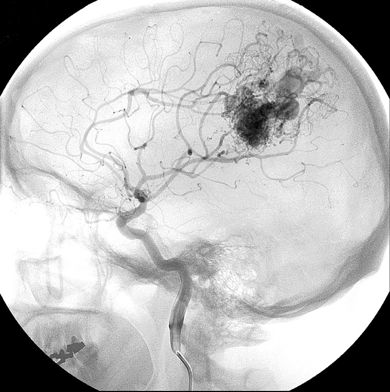 Arteriovenous Malformations